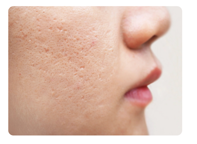 Laser Acne & Acne Scars