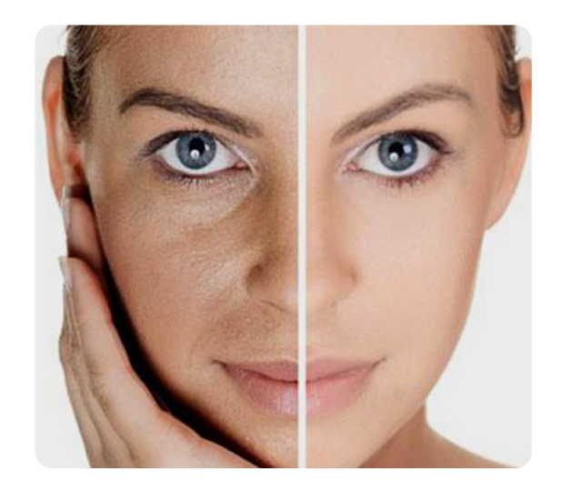 Fractional Resurfacing