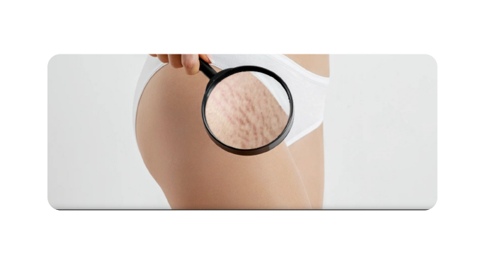Line Laser Stretch Marks
