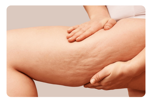 Orange Lase Cellulite