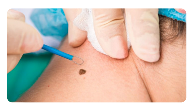 Mole / Wart / Skin Tags - Solar Lentigines / Spots - Skin