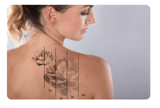 Tattoo Removal