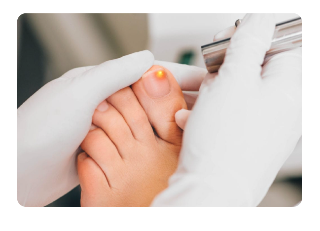 Nail Fungus