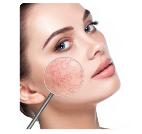 Capillaries / Veins And Vascular Lesions