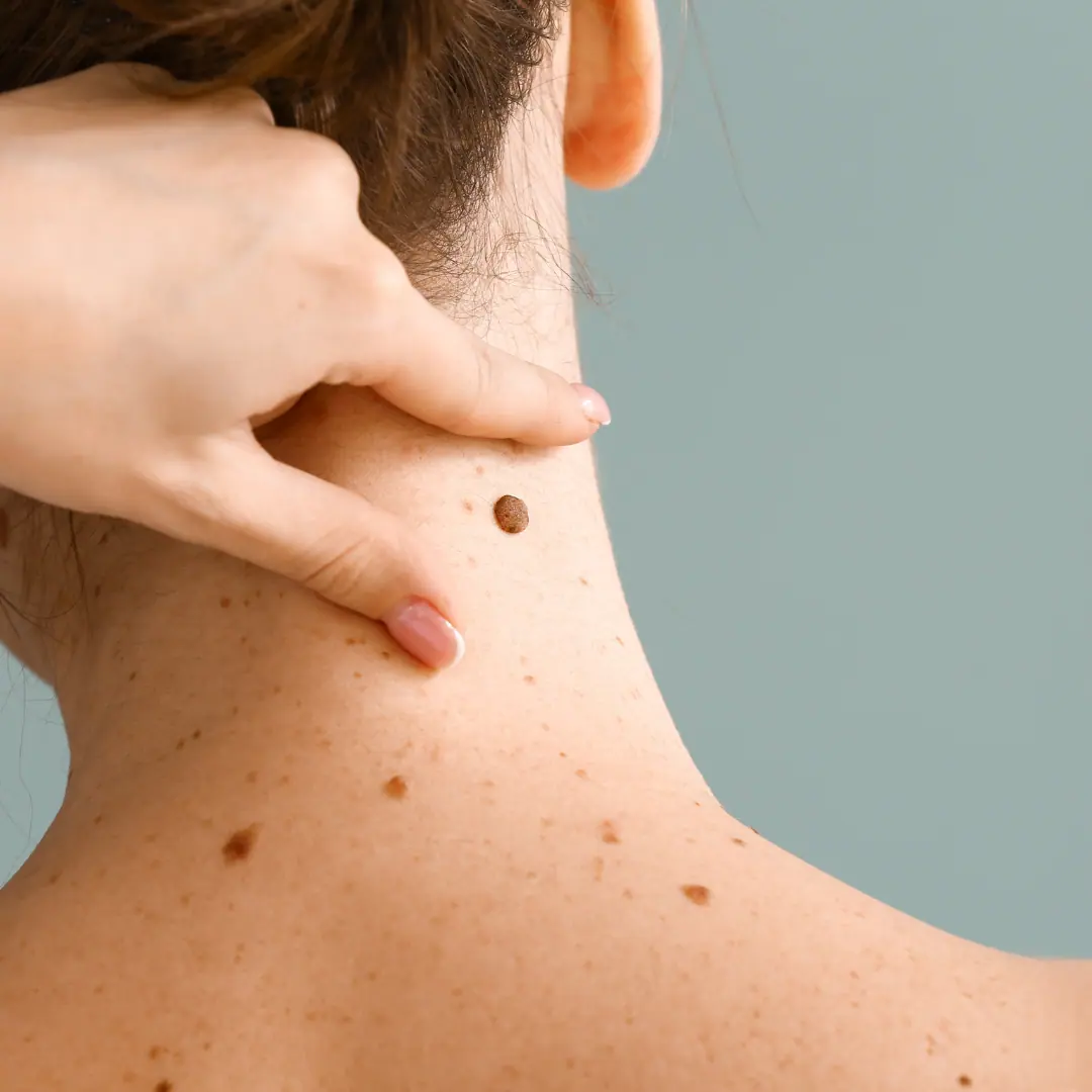 Skin Fibroids